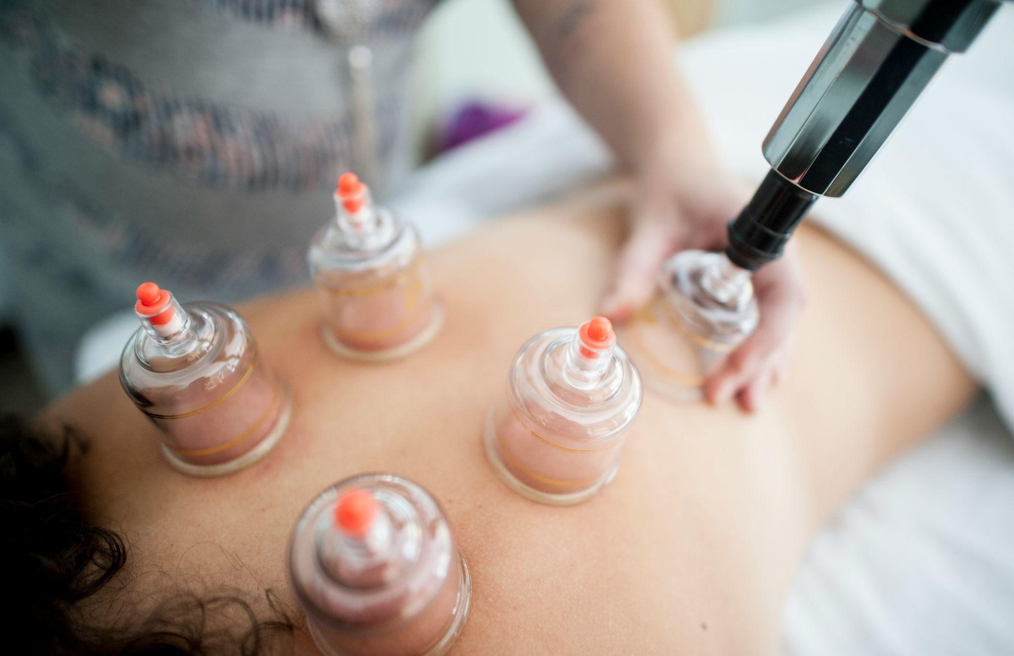 Demonstration of Cupping Therapy